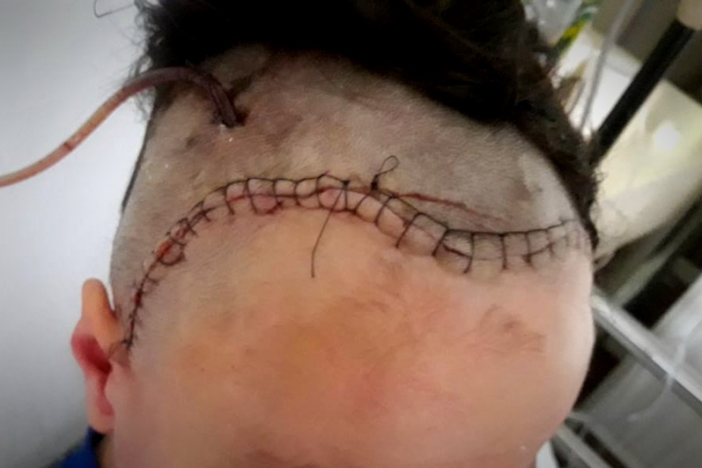 Lautaro esta con alta ambulatoria y se recupera favorablemente. Diariamente viaja al Garrahan, donde le suministran la medicación vía catéter.